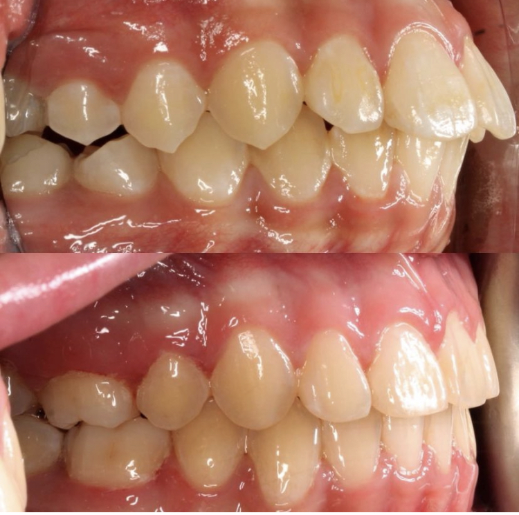 Invisalign_resultado (1)