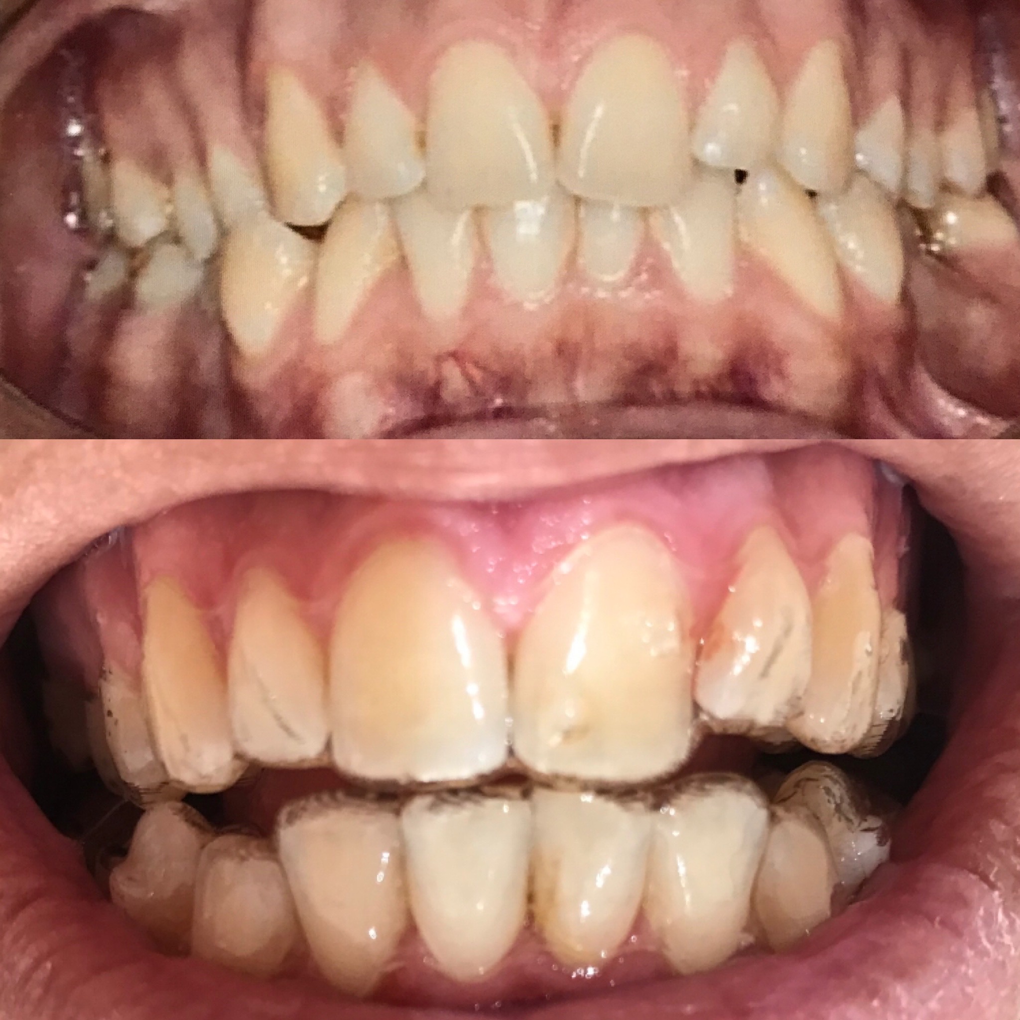 Invisalign_resultado (10)