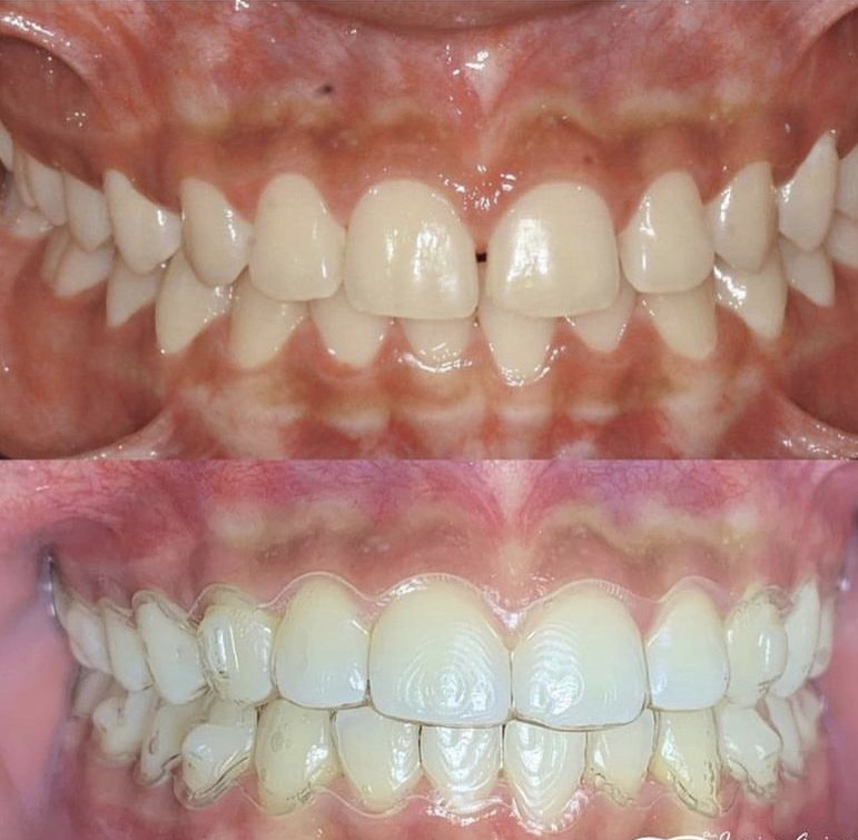Invisalign_resultado (12)