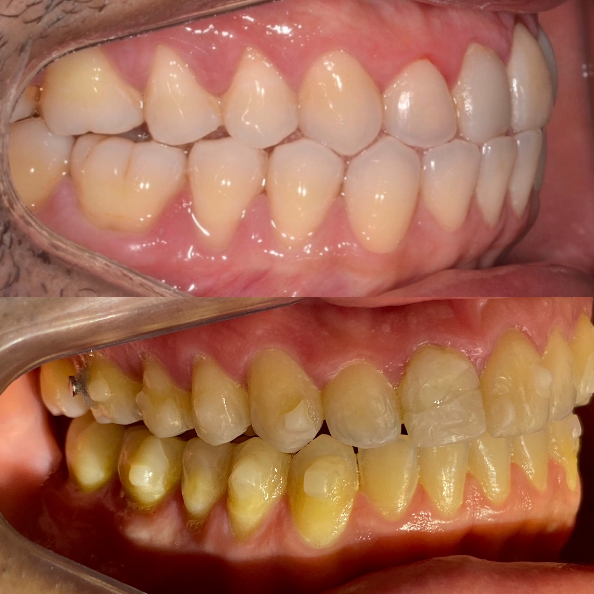 Invisalign_resultado (13)