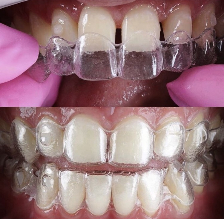 Invisalign_resultado (15)