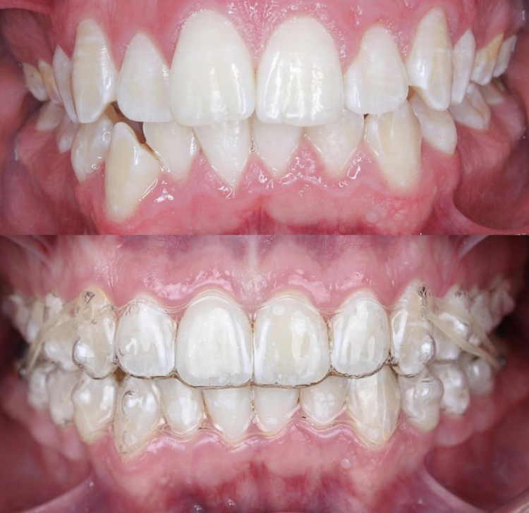 Invisalign_resultado (17)