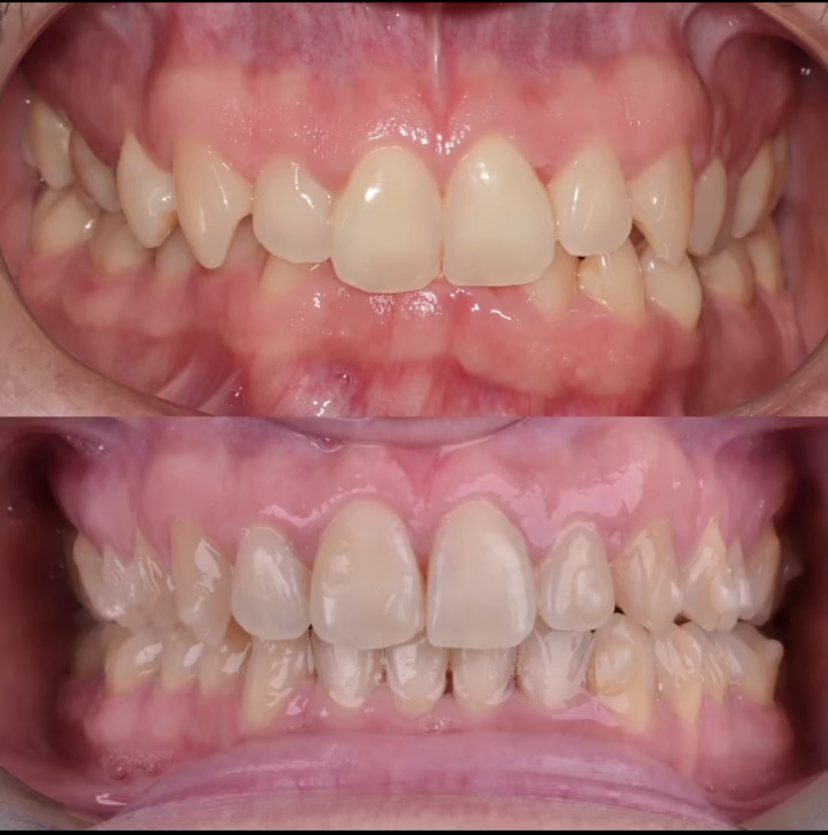 Invisalign_resultado (20)