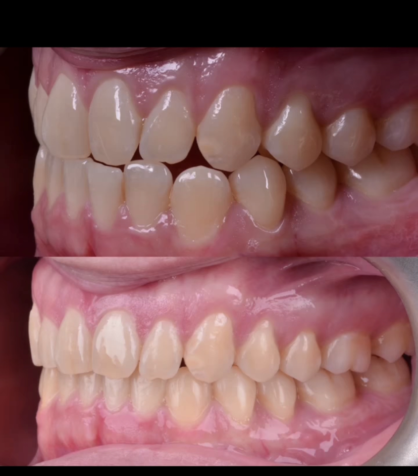 Invisalign_resultado (3)