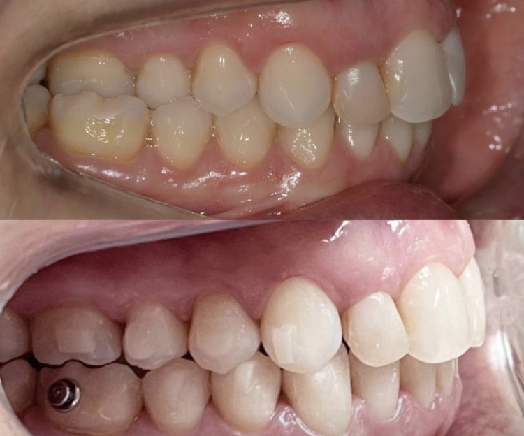 Invisalign_resultado (4)
