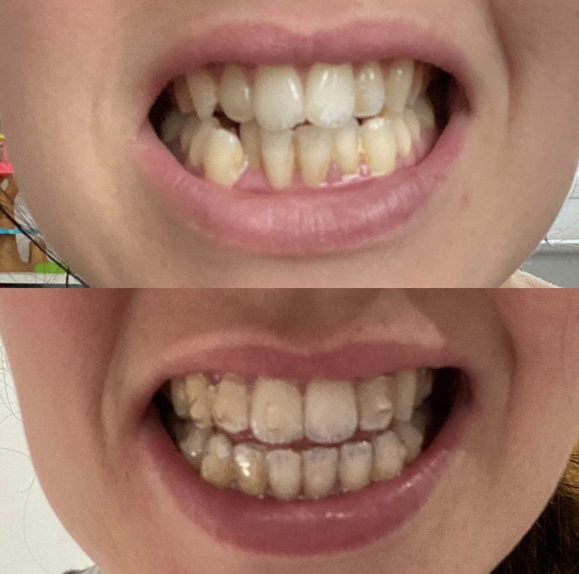 Invisalign_resultado (5)