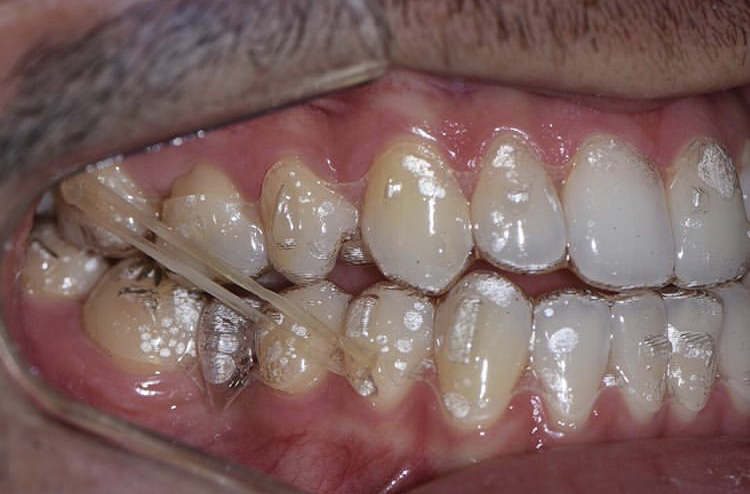 Invisalign_resultado (7)
