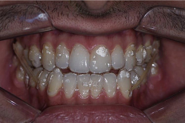 Invisalign_resultado (9)